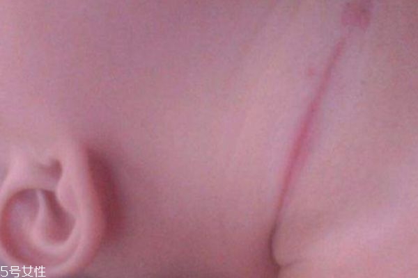 淹脖子是什么 怎么預(yù)防 淹脖子是什么 怎么預(yù)防