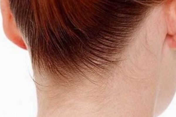 富貴包怎么消除 富貴包怎么形成的 富貴包怎么消除 富貴包怎么形成的