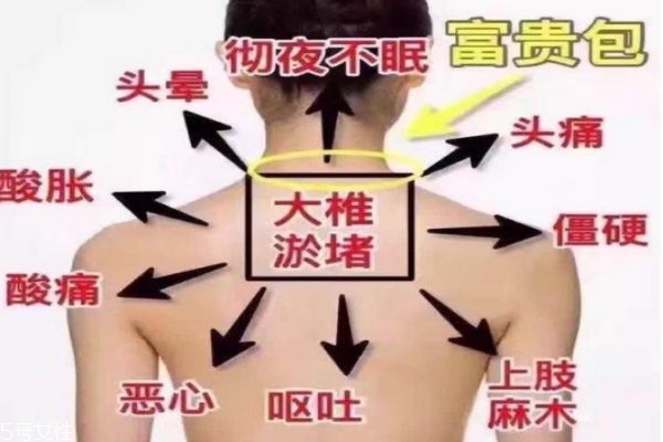 富貴包會引起什么病 教你如何預(yù)防 富貴包會引起什么病 教你如何預(yù)防