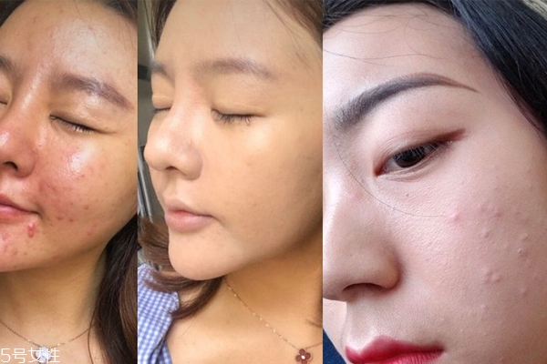 痘痘肌浮粉怎么辦 痘痘肌3個(gè)補(bǔ)妝小秘訣 痘痘肌浮粉怎么辦 痘痘肌3個(gè)補(bǔ)妝小秘訣