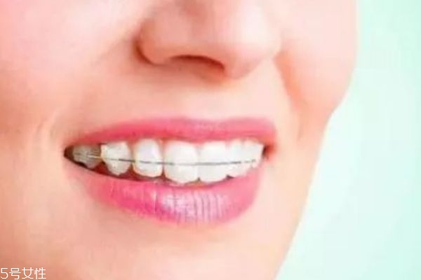 門牙縫隙大怎么辦 4種矯正方式 門牙縫隙大怎么辦 4種矯正方式