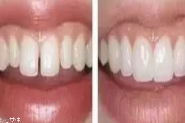 門牙縫隙大怎么辦 4種矯正方式 門牙縫隙大怎么辦 4種矯正方式