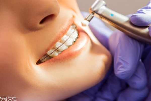 門牙縫隙大怎么辦 4種矯正方式 門牙縫隙大怎么辦 4種矯正方式