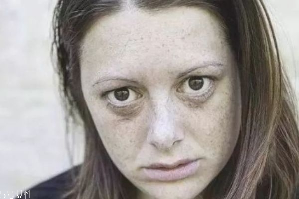 熬夜起痘痘怎么調(diào)理 熬夜的危害到底有多大 熬夜起痘痘怎么調(diào)理 熬夜的危害到底有多大