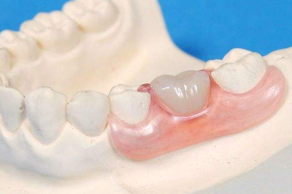 ?裝假牙后牙齦腫脹流血怎么辦 ?裝假牙后牙齦腫脹流血怎么辦