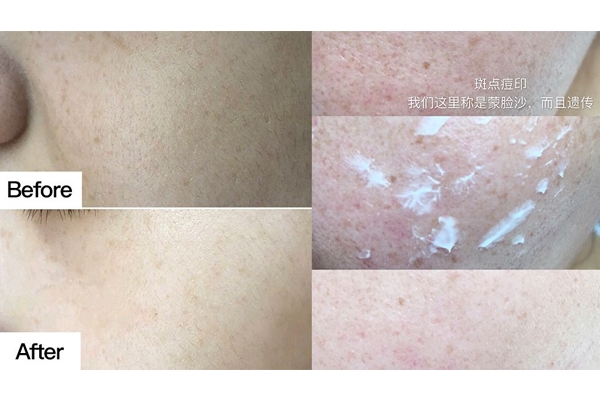 祛斑膏哪個(gè)牌子好 爆款祛斑膏推薦 祛斑膏哪個(gè)牌子好 爆款祛斑膏推薦