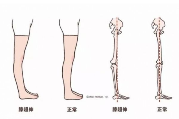 膝蓋超伸怎么矯正 如何正確處理膝超伸 膝蓋超伸怎么矯正 如何正確處理膝超伸