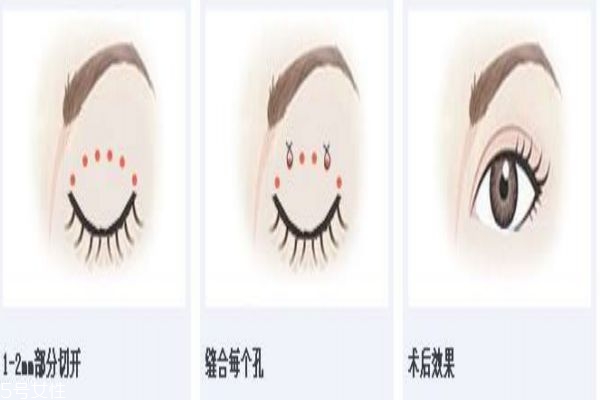 韓式三點(diǎn)雙眼皮的缺點(diǎn) 韓式三點(diǎn)雙眼皮的優(yōu)勢 韓式三點(diǎn)雙眼皮的缺點(diǎn) 韓式三點(diǎn)雙眼皮的優(yōu)勢