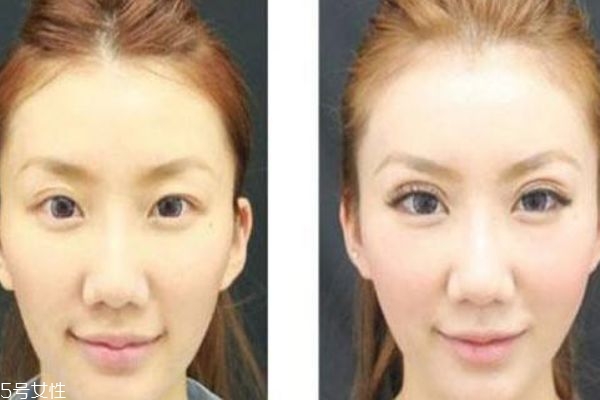 全切雙眼皮后不能吃什么 這三種絕對不能吃 全切雙眼皮后不能吃什么 這三種絕對不能吃