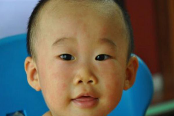 幼兒急疹的癥狀及治療 家長(zhǎng)們要注意