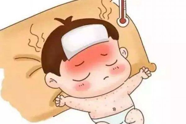 幼兒急疹和麻疹區(qū)別 3步看出寶寶是否是麻疹 幼兒急疹和麻疹區(qū)別 3步看出寶寶是否是麻疹
