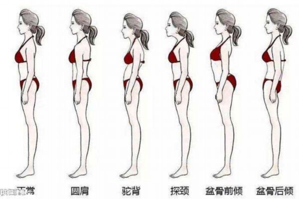 成年后駝背還能矯正嗎 駝背易混淆的癥狀 成年后駝背還能矯正嗎 駝背易混淆的癥狀