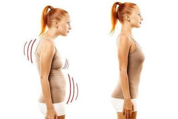 駝背是遺傳嗎 矯正駝背的幾種方法 駝背是遺傳嗎 矯正駝背的幾種方法