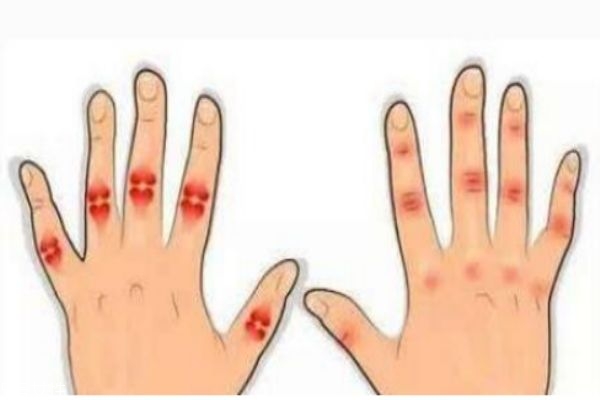 為什么年輕人會得風(fēng)濕 風(fēng)濕病的預(yù)防方法