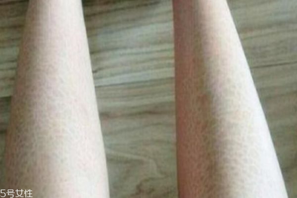 腿上皮膚干燥像魚(yú)鱗 有可能是魚(yú)鱗病