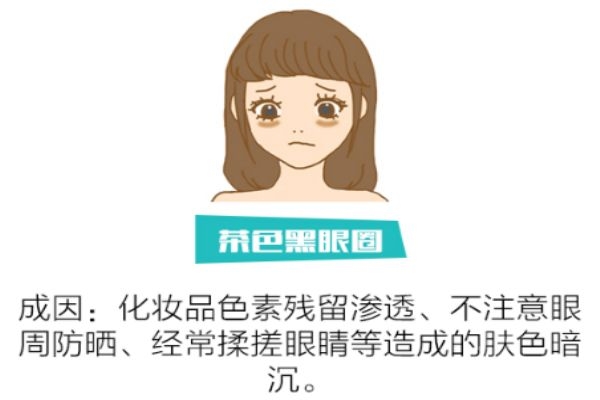 如何分辨黑眼圈類型 找對類型對癥下藥 如何分辨黑眼圈類型 找對類型對癥下藥