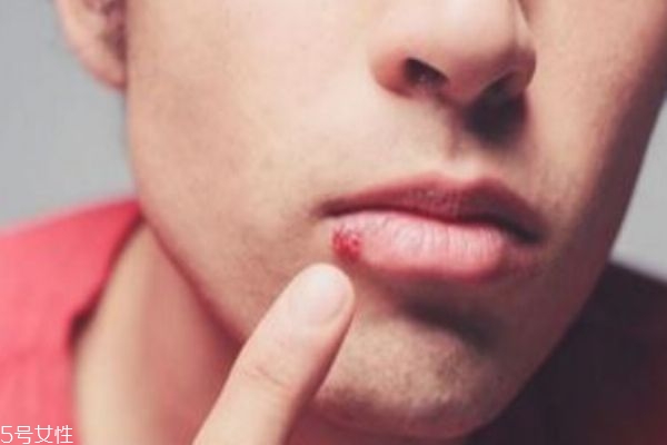 嘴巴長(zhǎng)皰疹怎么辦 有可能引發(fā)這些疾病 嘴巴長(zhǎng)皰疹怎么辦 有可能引發(fā)這些疾病