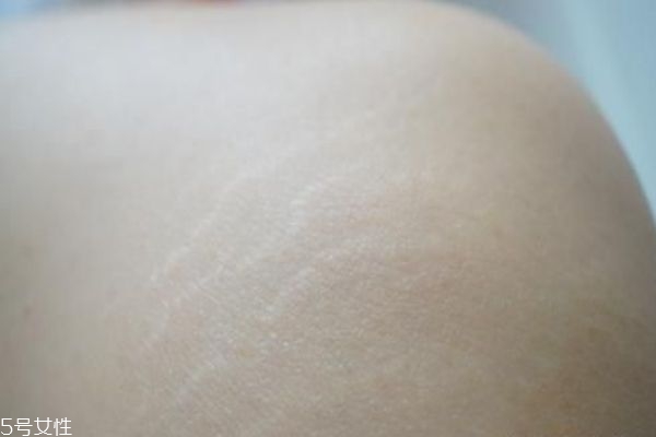 肥胖紋是胖了還是瘦了 消除肥胖紋最好的方法 肥胖紋是胖了還是瘦了 消除肥胖紋最好的方法