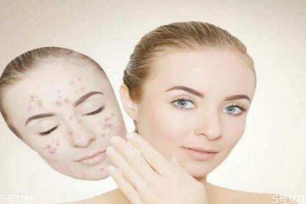 激素臉和過敏臉區(qū)別 治療激素臉要擺正心態(tài) 激素臉和過敏臉區(qū)別 治療激素臉要擺正心態(tài)