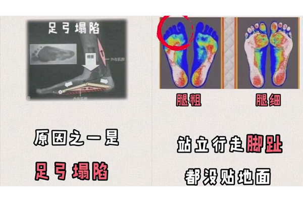 蘿卜腿怎么矯正圖解 坐著5分鐘消除蘿卜腿 蘿卜腿怎么矯正圖解 坐著5分鐘消除蘿卜腿