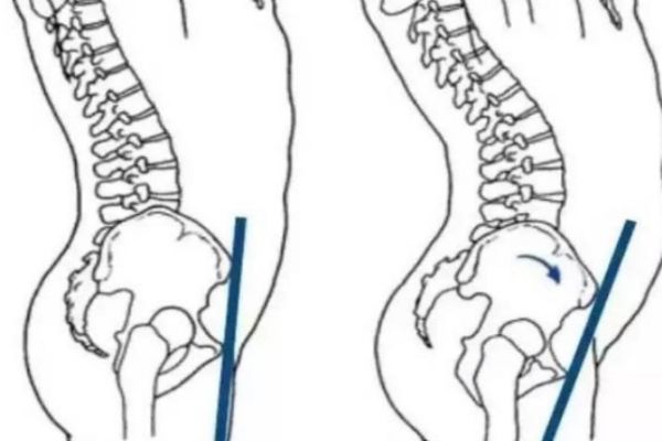 骨盆前傾的危害 3大危害你必須知道 骨盆前傾的危害 3大危害你必須知道