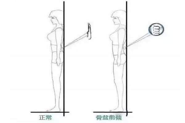 骨盆前傾的危害 3大危害你必須知道 骨盆前傾的危害 3大危害你必須知道