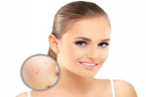 痘痘里為什么會有膿 臉上長膿痘怎么調(diào)理 痘痘里為什么會有膿 臉上長膿痘怎么調(diào)理