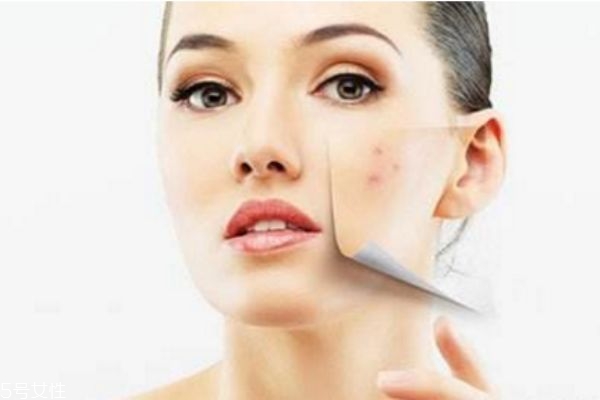 鼻子上長膿包型痘痘怎么處理 鼻子上長膿包多久會消 鼻子上長膿包型痘痘怎么處理 鼻子上長膿包多久會消