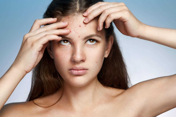 去痘印最有效的方法 愛美的你怎能不學