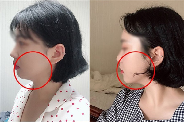 耳貼減肥有效嗎 耳貼減肥有人用過(guò)嗎 耳貼減肥有效嗎 耳貼減肥有人用過(guò)嗎