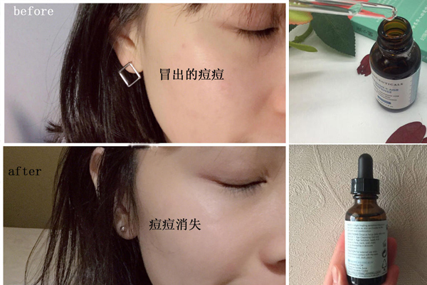 修麗可果酸精華液祛痘效果好嗎 戰(zhàn)痘力超強神器 修麗可果酸精華液祛痘效果好嗎 戰(zhàn)痘力超強神器