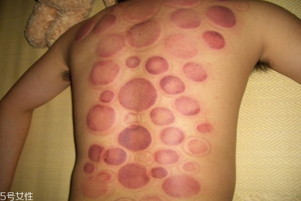 肚子減肥拔罐子拔哪個穴位 肚子減肥拔罐子拔哪個穴位