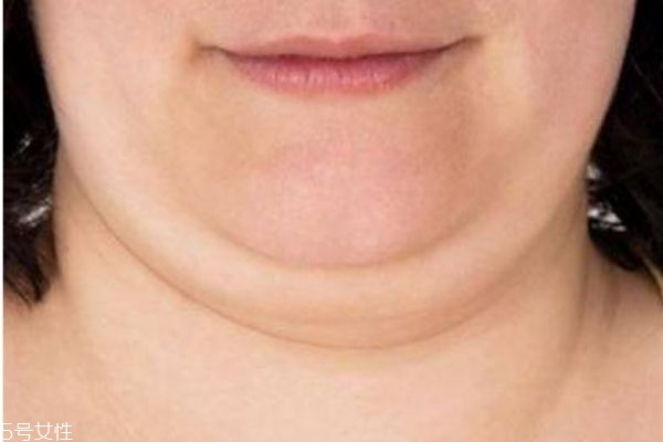 面部吸脂危險(xiǎn)嗎 面部吸脂之后有什么危害 面部吸脂危險(xiǎn)嗎 面部吸脂之后有什么危害