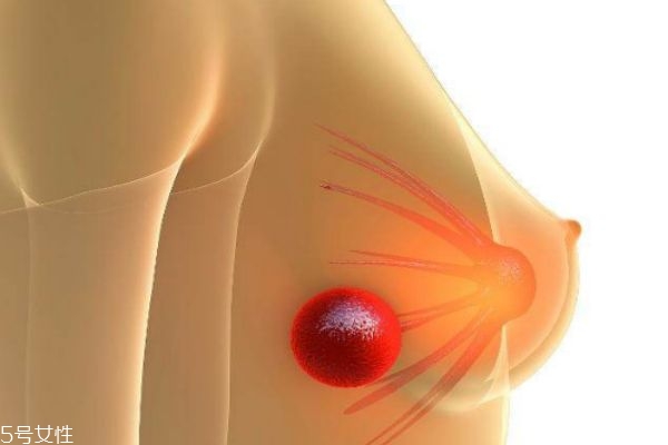 乳腺結(jié)節(jié)可以消除嗎 什么樣的乳腺結(jié)節(jié)屬于乳腺癌 乳腺結(jié)節(jié)可以消除嗎 什么樣的乳腺結(jié)節(jié)屬于乳腺癌