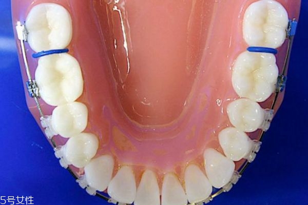 牙齒整形有哪些方法 關(guān)于牙齒整形的那些事 牙齒整形有哪些方法 關(guān)于牙齒整形的那些事
