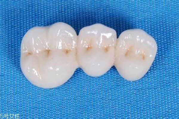 美容冠矯正牙齒好不好 美容冠矯正牙齒好處和壞處 美容冠矯正牙齒好不好 美容冠矯正牙齒好處和壞處