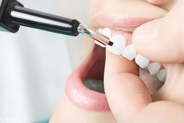 做牙齒整形會痛嗎 看個人承受能力 做牙齒整形會痛嗎 看個人承受能力