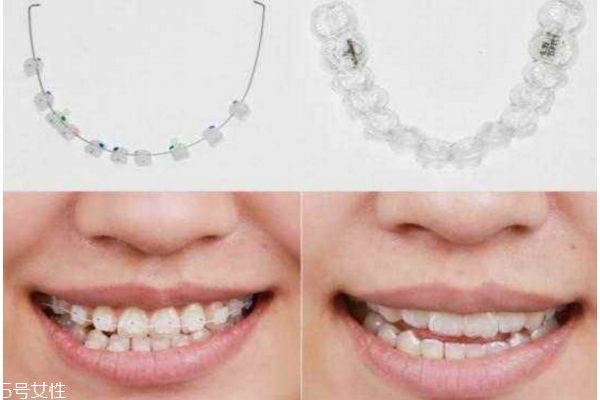 牙齒整形有哪些方法 關(guān)于牙齒整形的那些事 牙齒整形有哪些方法 關(guān)于牙齒整形的那些事