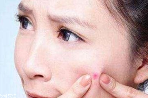 痤瘡如何治療效果好 痤瘡最佳治療方法 痤瘡如何治療效果好 痤瘡最佳治療方法