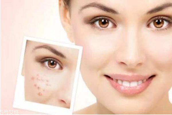 痤瘡如何治療效果好 痤瘡最佳治療方法 痤瘡如何治療效果好 痤瘡最佳治療方法