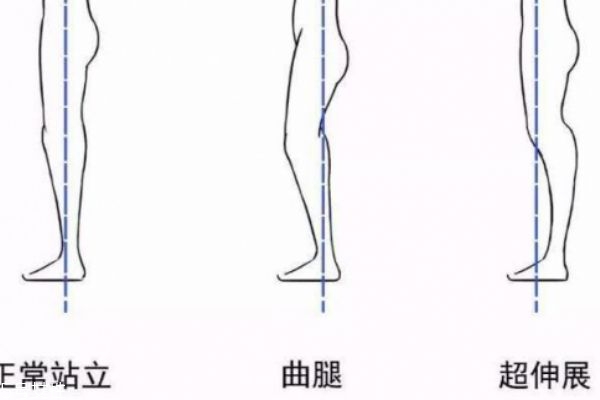 膝關(guān)節(jié)超伸的危害 會導(dǎo)致以下疾病 膝關(guān)節(jié)超伸的危害 會導(dǎo)致以下疾病