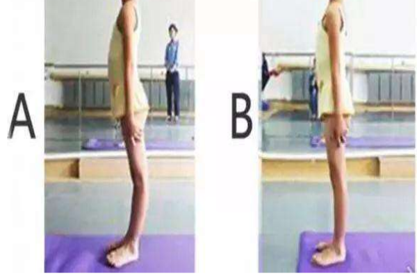 如何改善膝關(guān)節(jié)超伸 什么是膝蓋超伸 如何改善膝關(guān)節(jié)超伸 什么是膝蓋超伸