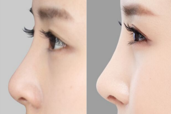 隆鼻有幾種方式 假體隆鼻的危害 隆鼻有幾種方式 假體隆鼻的危害