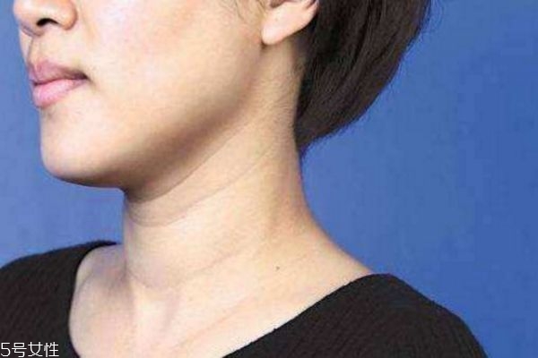很年輕為什么就有頸紋 頸紋是這樣長(zhǎng)出來(lái)的 很年輕為什么就有頸紋 頸紋是這樣長(zhǎng)出來(lái)的