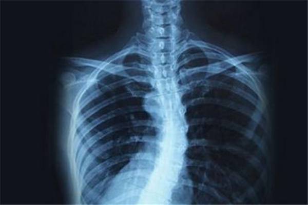脊椎側(cè)彎造成胸悶、背部疼痛