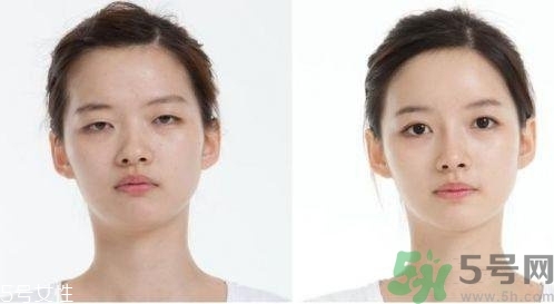 雙眼皮埋線可以重做嗎?雙眼皮埋線可以拆嗎? 雙眼皮埋線可以重做嗎?雙眼皮埋線可以拆嗎?