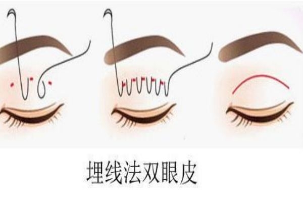 埋線雙眼皮感染怎么辦？埋線雙眼皮發(fā)炎了怎么辦