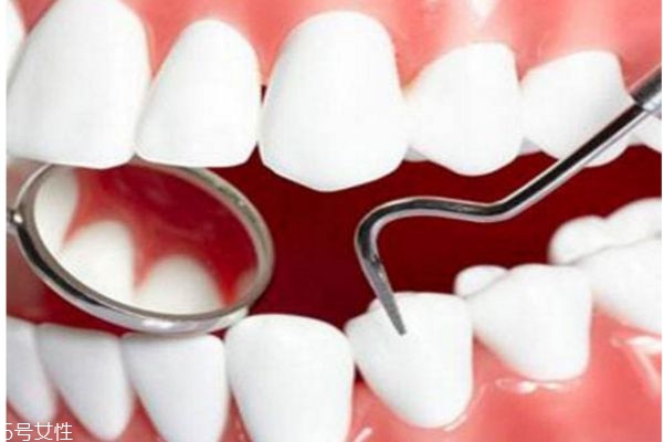 洗牙后怎么刷牙 洗牙對牙齒的好處 洗牙后怎么刷牙 洗牙對牙齒的好處