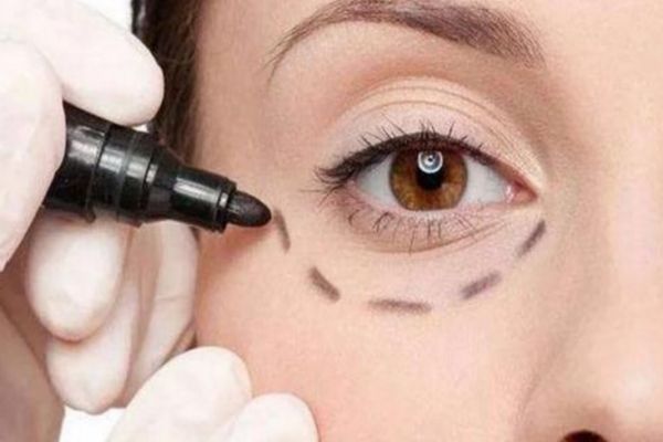 內(nèi)切眼袋多久可以消腫 內(nèi)切眼袋手術(shù)用拆線嗎