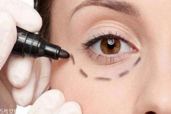 內切眼袋多久可以消腫 內切眼袋手術用拆線嗎 內切眼袋多久可以消腫 內切眼袋手術用拆線嗎